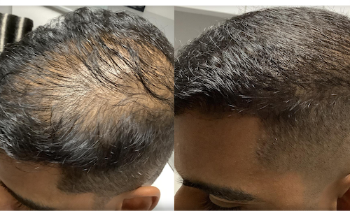 PRP Hair Loss Solution Men - Mississauga Oakville